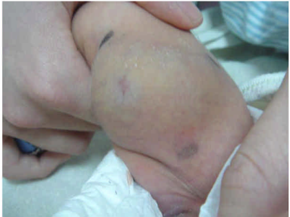  皮下出血（ subcutaneous hemorrhage ） Evans  症候群