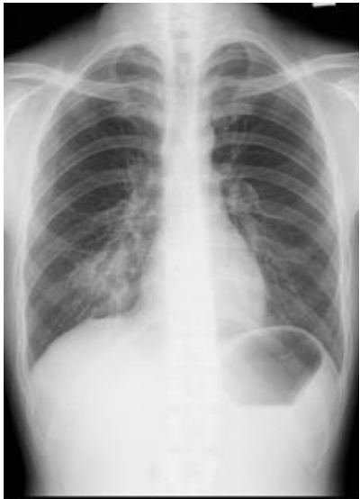  perforated peptic ulcer  acute hepatitis